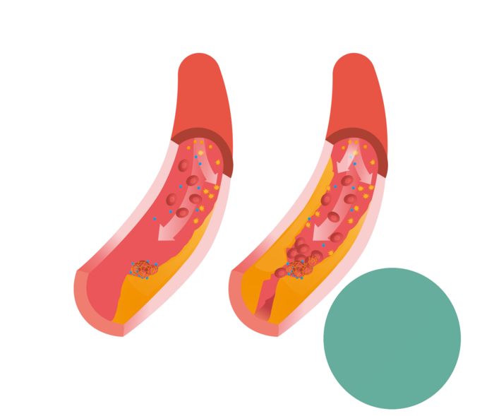Die Illustrationen zeigen den Unterschied zwischen einer beginnenden und einer starken Atherosklerose (rechts)