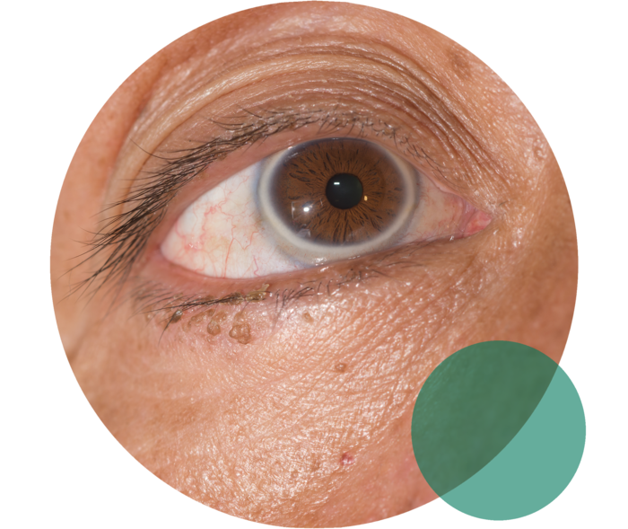 Ein geöffnetes Auge. Um die Iris zeigt sich ein trüber, milchig-weißer Ring.