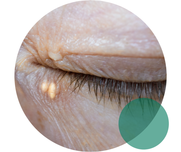 Ein geschlossenes Auge. Unterhalb des Auges sind an der Haut zwei gelbliche Ablagerungen zu sehen.