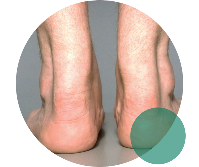 Zwei auf dem Boden stehende Füße von hinten. Die Achillessehnen der Füße sind verdickt.