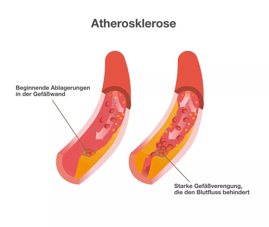 Grafik mit der Überschrift „Atherosklerose“. Sie zeigt zwei Blutgefäße. Im linken Gefäß sind wenige gelbliche Ablagerungen zu sehen. Beschriftung: „Beginnende Ablagerungen in den Gefäßwänden“. Im rechten Blutgefäß sind rechts und links stark ausgeprägte gelbliche Ablagerungen zu sehen. Beschriftung: „Starke Gefäßverengung, die den Blutfluss behindert“.