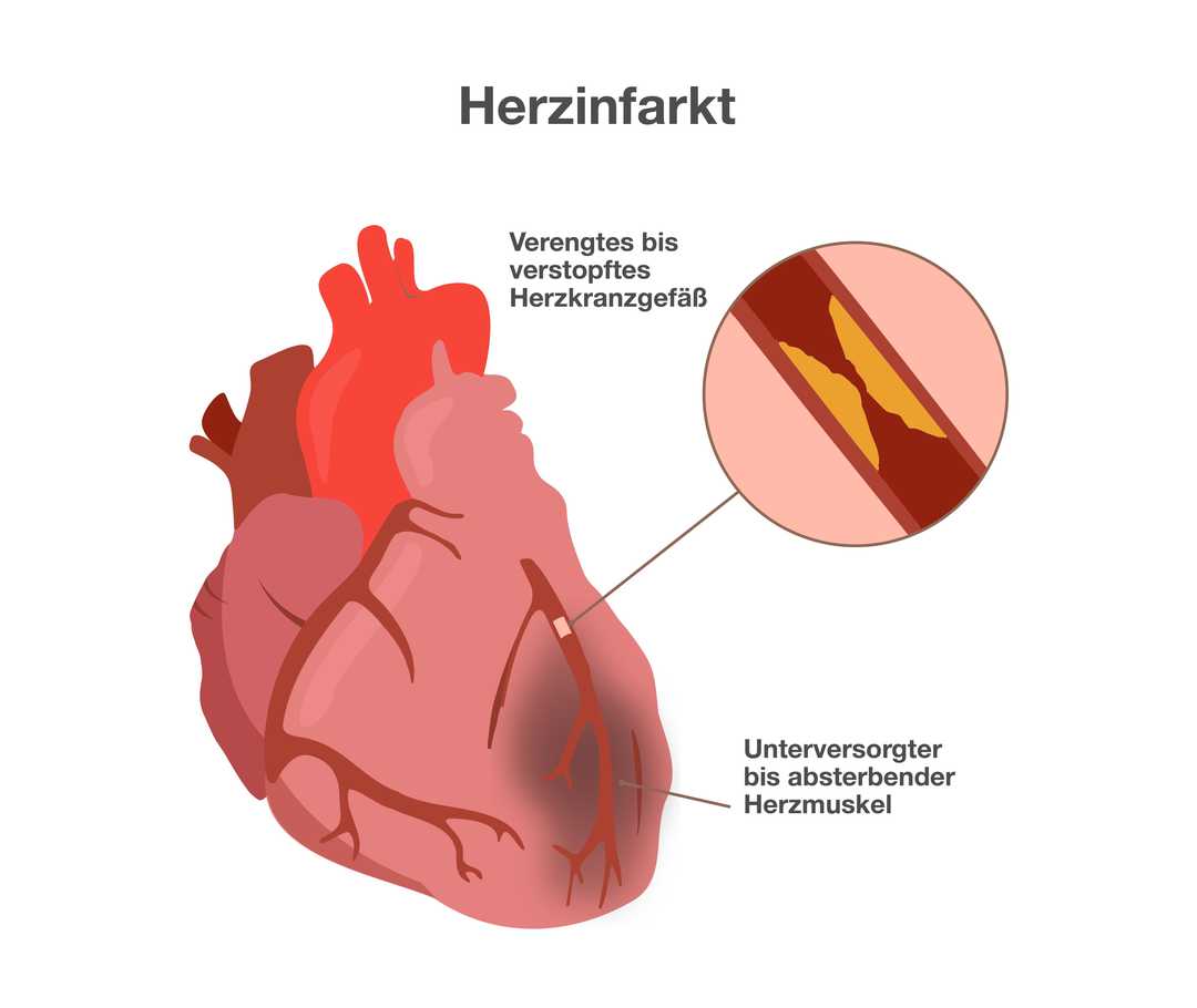 Eine Grafik mit der Überschrift „Herzinfarkt“. Anatomische Darstellung eines Herzens mit Herzkranzgefäß. Eine Stelle unter dem Herzkranzgefäß ist gräulich verfärbt. Beschriftung: „Unterversorgter bis absterbender Herzmuskel“. Rechts neben dem Herzen die vergrößerte Ansicht des Herzkranzgefäßes. Sie zeigt eine schmale Röhre, die durch gelbliche Ablagerungen verengt ist. Beschriftung: „Verengtes bis verstopftes Herzkranzgefäß“.