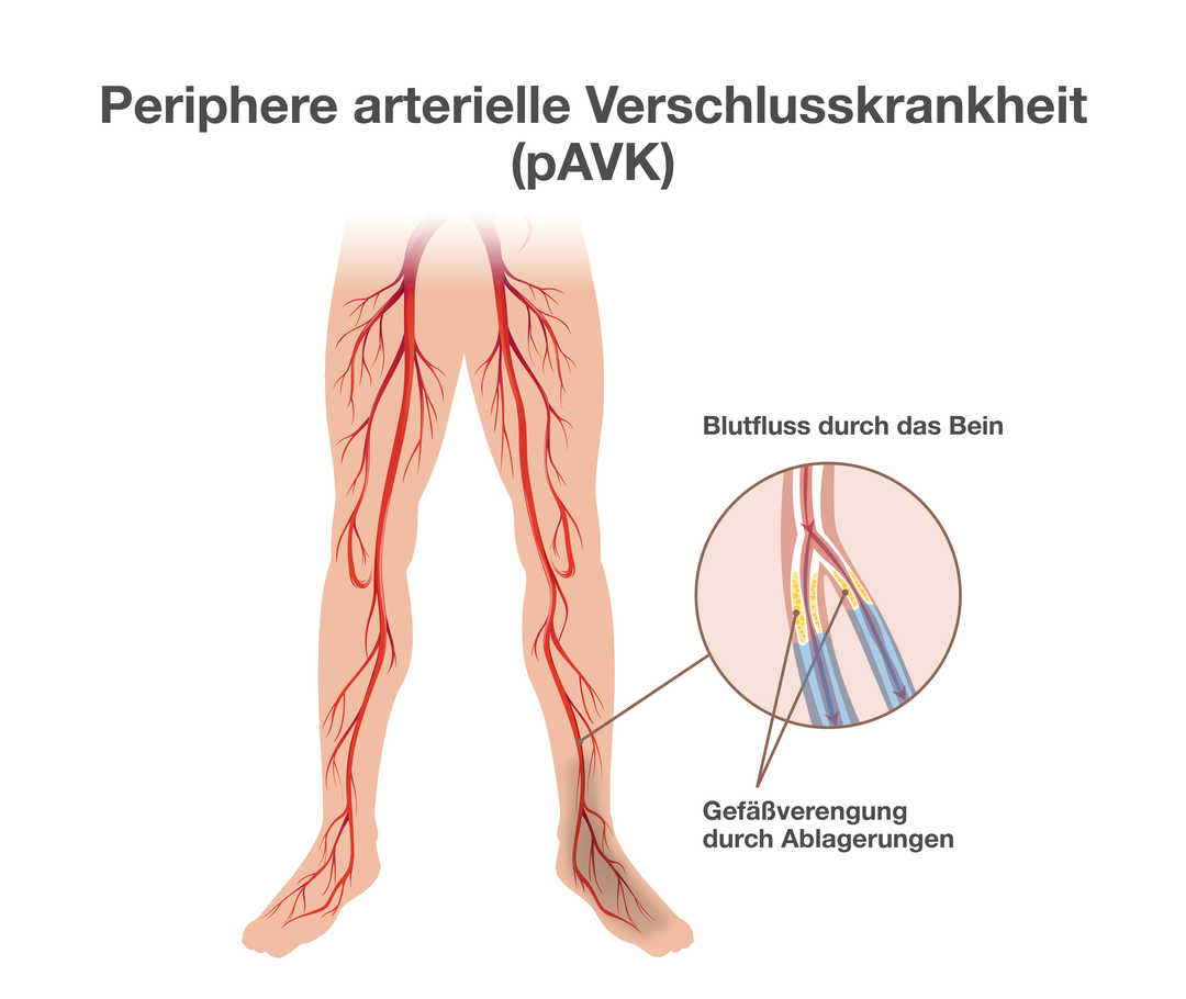 Grafik mit der Überschrift „Periphere arterielle Verschlusskrankheit (pAVK)“. Sie zeigt Beine eines Menschen mit rot gefärbten Blutgefäßen. Rechts daneben die vergrößerte Ansicht eines Blutgefäßes mit zwei Abzweigungen. Überschrift: „Blutfluss durch das Bein“. In den beiden Abzweigungen sind gelbe Ablagerungen zu erkennen. Unterhalb der Ablagerungen sind die Abzweigungen blau gefärbt. Beschriftung: „Gefäßverengung durch Ablagerungen“. 