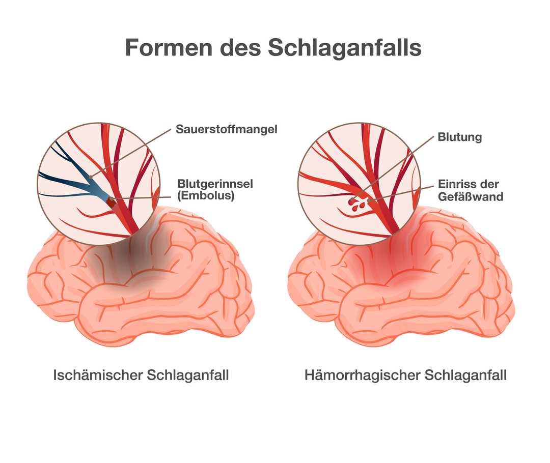 Grafik mit der Überschrift „Formen des Schlaganfalls“. Dargestellt sind zwei Gehirne. Links die Darstellung des ersten Gehirns. Beschriftung: „Ischämischer Schlaganfall“. Die Vergrößerung eines Bereichs zeigt Blutgefäße im Gehirn. Die Abzweigung eines Blutgefäßes ist blau verfärbt. Beschriftung: „Sauerstoffmangel“. Unterhalb der blauen Verfärbung ist ein Blutgerinnsel zu erkennen. Beschriftung: „Blutgerinnsel (Embolus)“. Rechts die Darstellung des zweiten Gehirns. Beschriftung „Hämorrhagischer Schlaganfall“