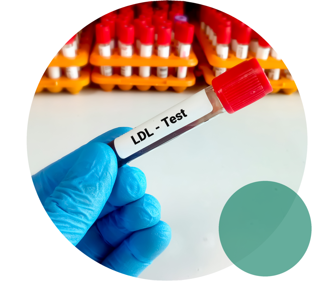 Eine Hand im blauen Einweghandschuh hält ein Probenröhrchen mit der Aufschrift „LDL-Test“.
