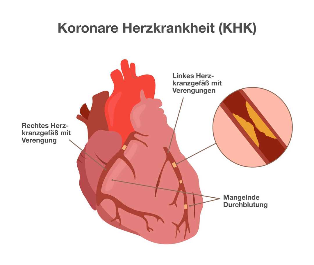 Eine Grafik mit der Überschrift: Koronare Herzkrankheit (KHK). Anatomische Darstellung eines Herzens mit den Herzkranzgefäßen. Über das Herz ziehen sich Blutgefäße. Beschriftung eines der Gefäße mit: Rechtes Herzkranzgefäß mit Verengung. Beschriftung eines anderen Gefäßes mit: Linkes Herzkranzgefäß mit Verengungen. Vergrößerte Darstellung eines Teils des linken Herzkranzgefäßes. Untere Teile des Herzens beschriftet mit: Mangelnde Durchblutung.