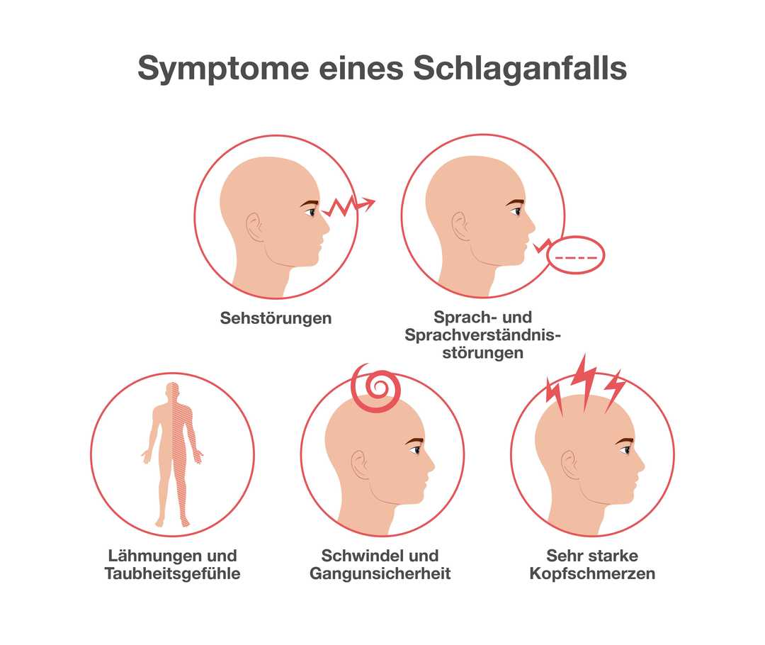 Grafik bestehend aus fünf Kreisen mit der Überschrift: Symptome eines Schlaganfalls. Zwei Kreise in der oberen Reihe der Grafik, darunter drei weitere Kreise. Im ersten Kreis schematische Darstellung eines menschlichen Kopfes. Von den Augen geht ein gezackter Pfeil ab. Kreis beschriftet mit: Sehstörungen. Zweiter Kreis zeigt schematische Darstellung eines Kopfes. Vom Mund geht eine Sprechblase aus, die mit kurzen Strichen gefüllt ist. Beschriftung des Kreises mit: Sprech- und Sprachverständnisstörung. Dritt